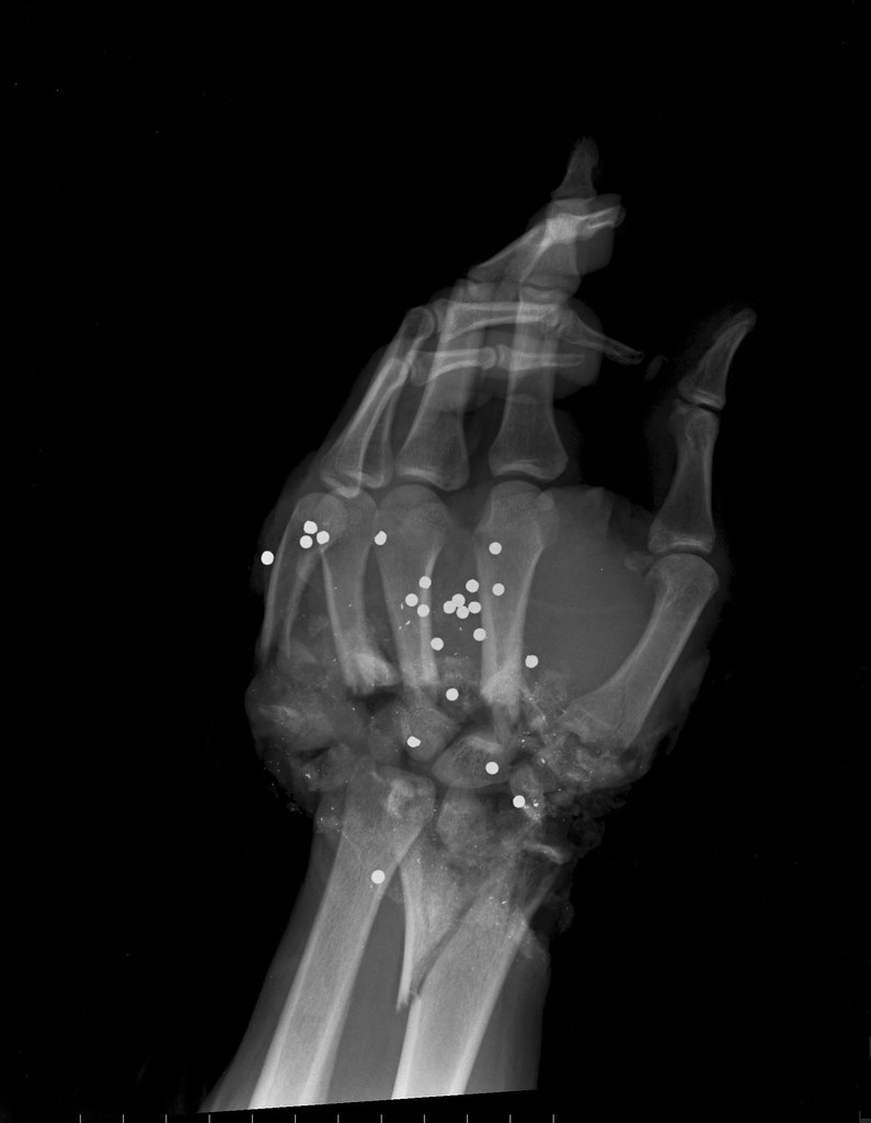 A gunshot wound on a hand.