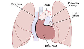 A heart being removed from a person's chest