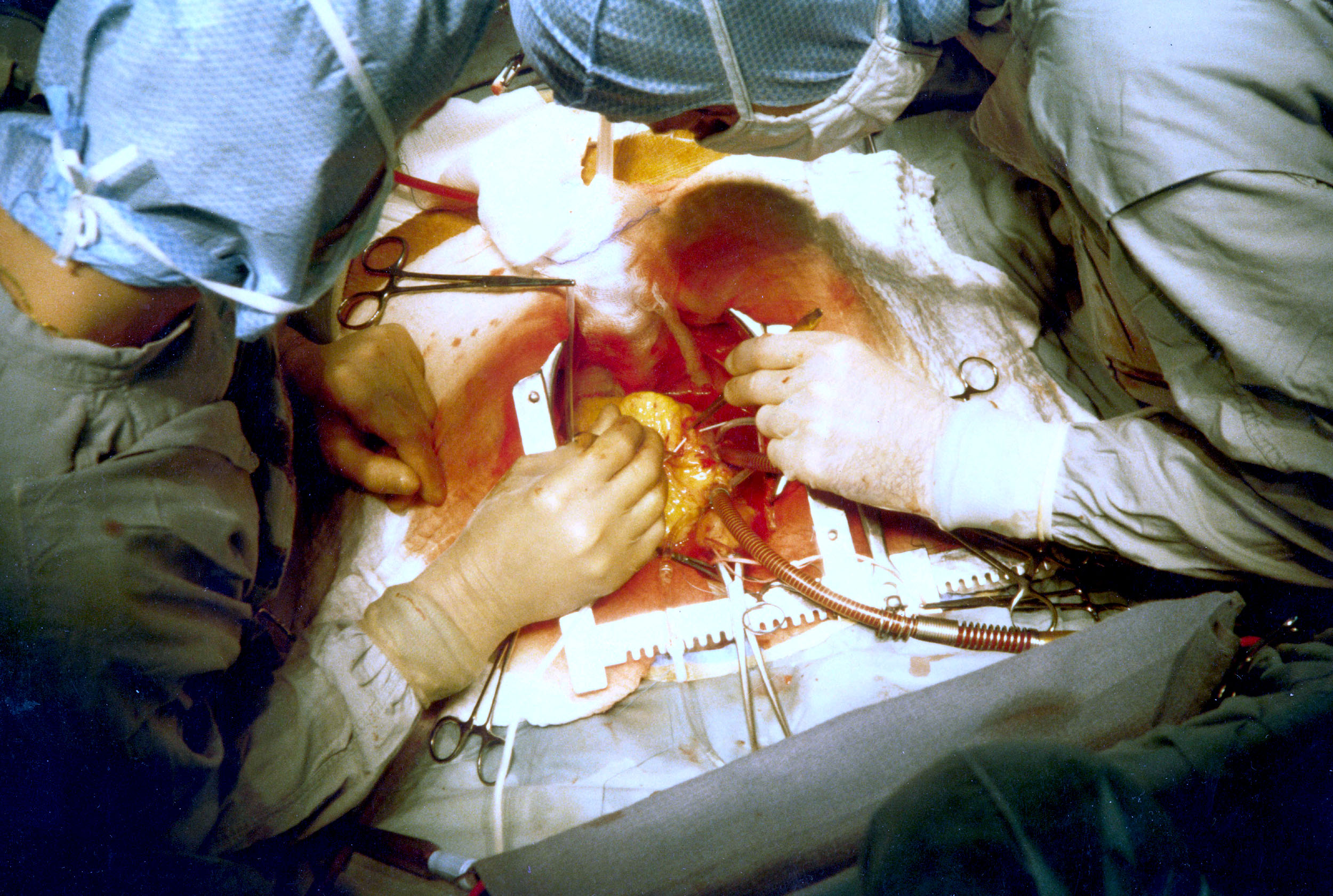 A heart being removed surgically.