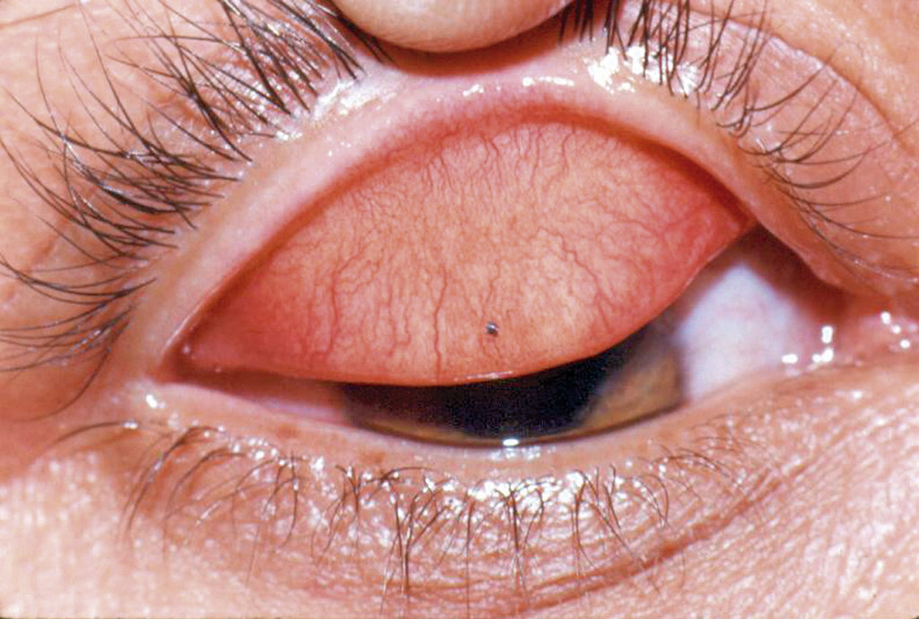 An eye with a missing or closed eyelid.