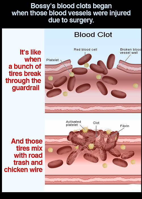 Blood clot diagram