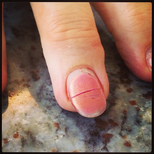 Broken or damaged fingernails.