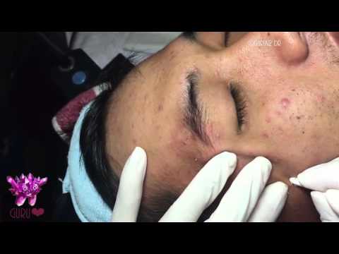 Cyst dreams and popping acne.