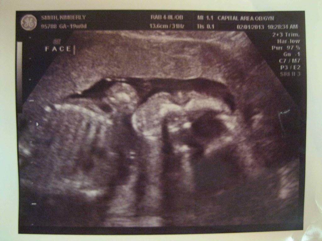 Ultrasound image of a baby's face.